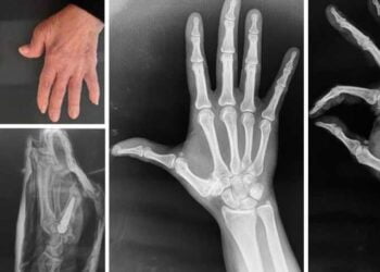 Protesi articolare per pazienti con artrosi del pollice, Policlinico di Bari: nuova tecnica chirurgica