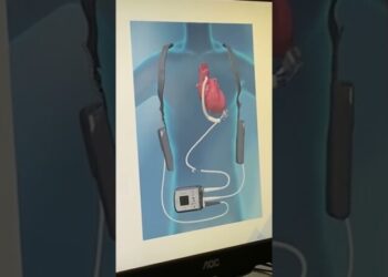 Bari, cuore artificiale a paziente 65enne. Preleva sangue da ventricolo sinistro e lo pompa nell’aorta