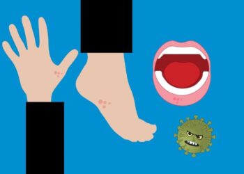 Moltiplicati i casi di “mani bocca piedi” tra i bambini, i consigli del pediatra: contagiosa per un mese
