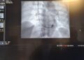 Stent