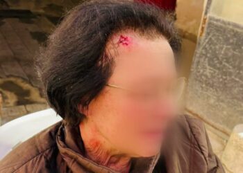 Cade Su Marciapiedi Rotto Dell’ex Manifattura E Si Frattura Il Braccio, Bratta: “ennesimo Episodio” – Video