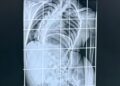 Radiografia Della Colonna Vertebrale Pre Intervento